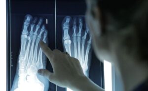 Dedos en martillo y en mazo: una deformidad común que afecta más a mujeres